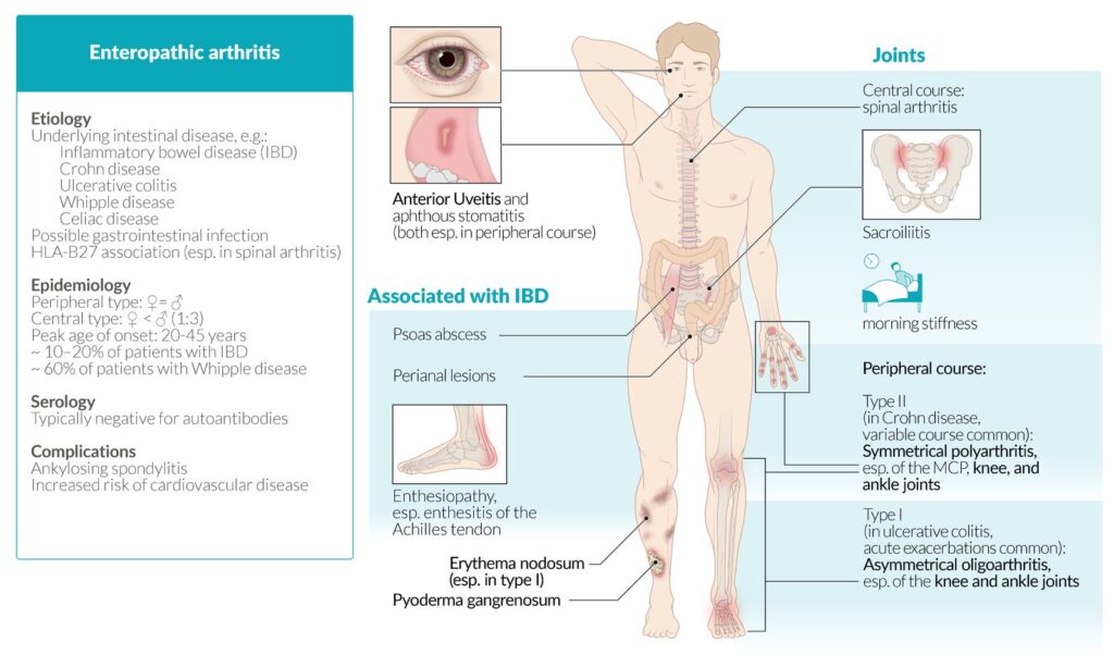 La arteritis enteropática es una condición inflamatoria de los vasos sanguíneos que afecta principalmente a pacientes con enfermedades inflamatorias intestinales, como la enfermedad de Crohn y la colitis ulcerosa