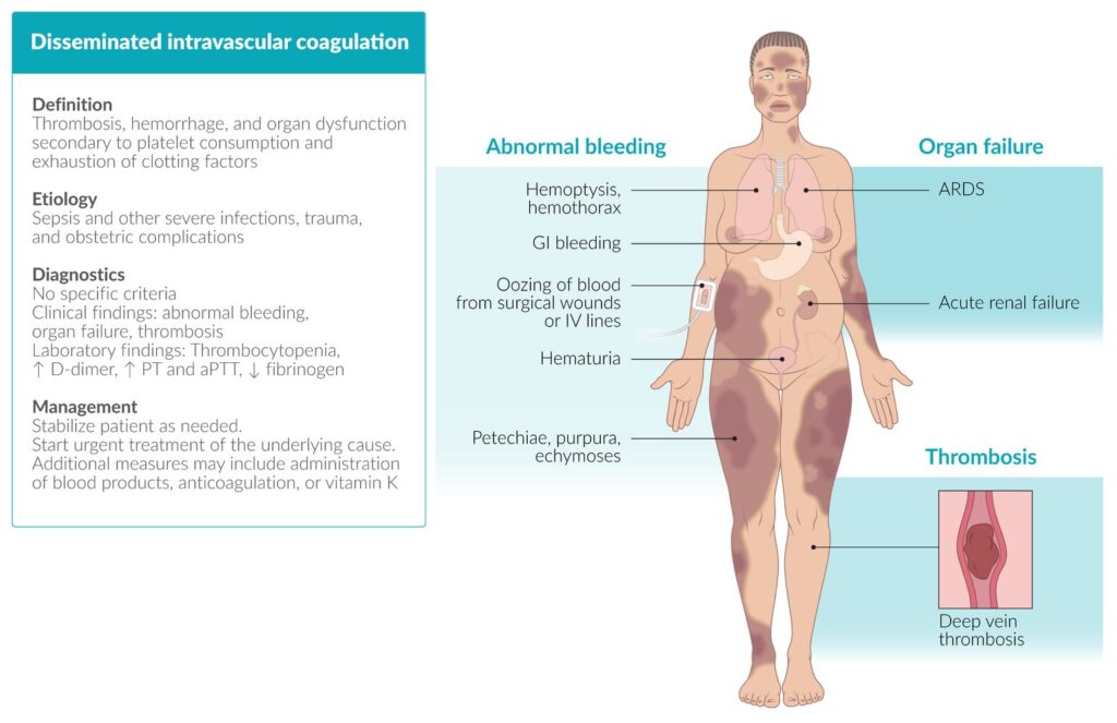 COAGULACIÓN INTRAVASCULAR DISEMINADA