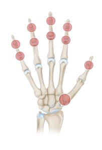 Patrón de distribución de la osteoartritis de la mano.