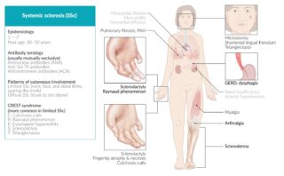 OSTEOARTROSIS