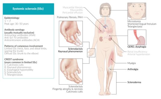 ESPONDILOARTRITIS