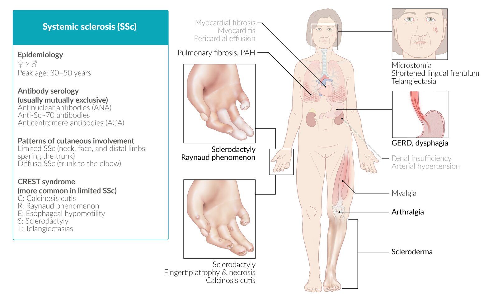 Esclerodermia