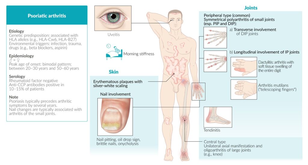 Psoriatic arthritis