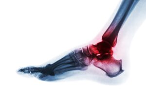 Arthritis of ankle . X-ray of foot . Lateral view . Invert color style . Gout or Rheumatoid concept .