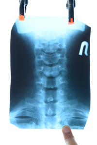 Espondiloartritis