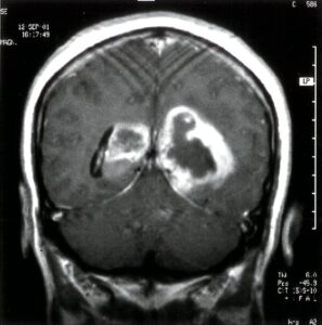 Glioblastoma bilateral