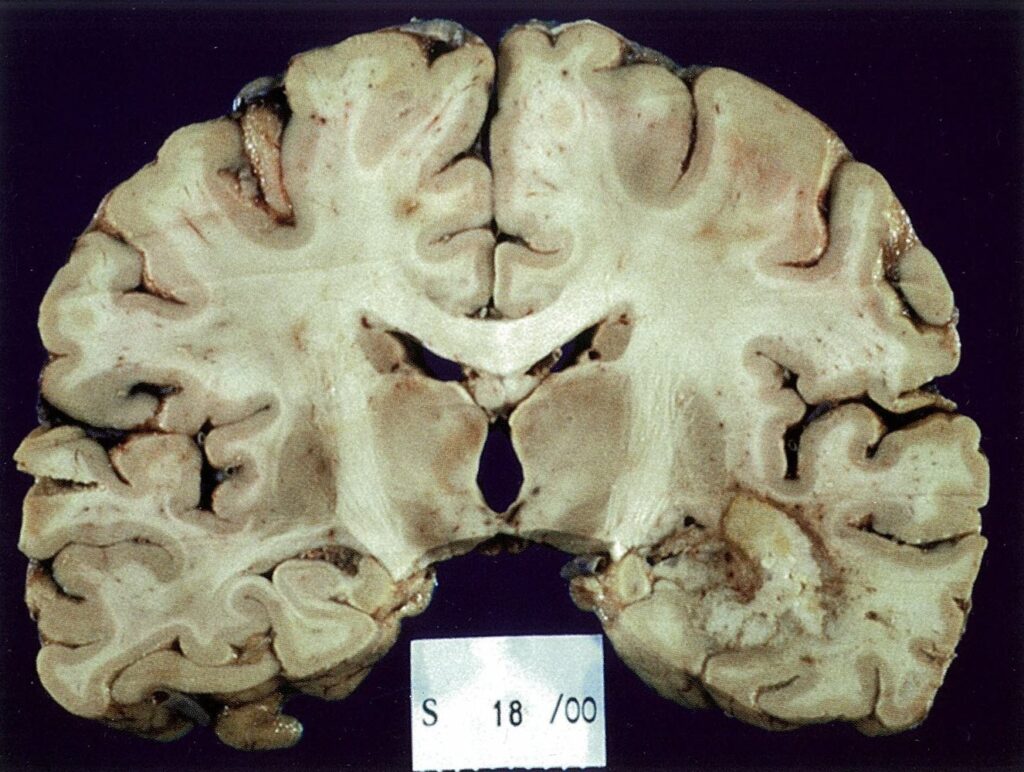 Glioblastoma en lóbulo temporal