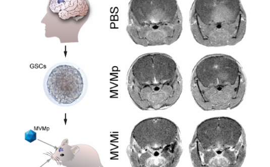 Glioblastoma