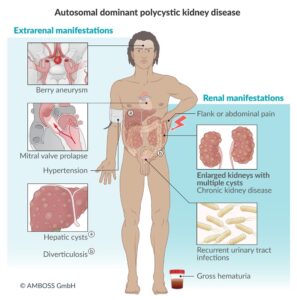 Enfermedad renal poliquística