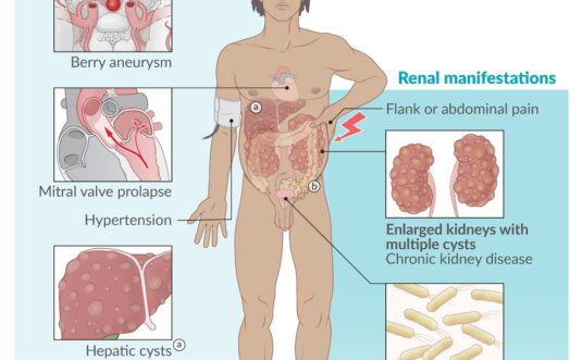 Tratamiento Quirúrgico de la Necrosis Pancreática