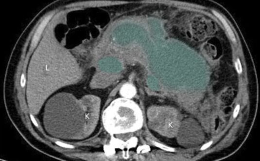 Cetoacidosis Euglucémica: Un Desafío Diagnóstico para los Médicos