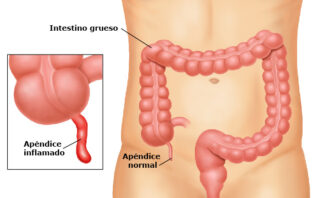 Manejo de la Hipertensión Intracraneal