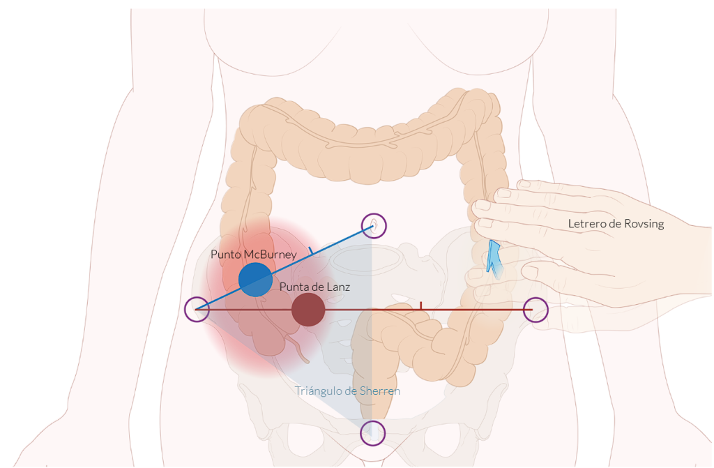 Representación anatómica de los principales puntos apendiculares y signos clínicos en la exploración de la apendicitis. Se destacan el Punto de McBurney y la Punta de Lanz, así como el Triángulo de Sherren, utilizados en la evaluación del dolor abdominal en sospecha de apendicitis. También se ilustra el Signo de Rovsing, una maniobra exploratoria que indica irritación peritoneal.