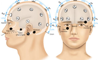 Manejo de la Hipertensión Intracraneal