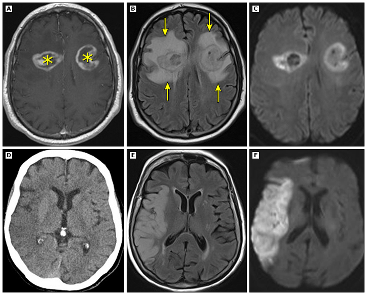 (A, B y C) Hombre de 63 años con glioblastoma multifocal. Las resonancias magnéticas poscontraste ponderadas en T1 (A) y FLAIR (B) muestran tumores con realce del reborde bifrontal (*). El edema vasogénico rodea ambas lesiones y es FLYAIR hiperintenso (flechas). Aunque hay una difusividad reducida en las paredes tumorales debido a la hipercelularidad en las imágenes ponderadas por difusión de trazas (C), no hay una difusión reducida en el edema vasogénico circundante.

(D, E y F) de 97 años con infarto isquémico agudo. La TC (D) sin contraste y la RMN FLAIR (E) muestran hipodensidad e hiperintensidad de señal anormales, respectivamente, en la ínsula derecha, el opérculo parietal y el lóbulo parietal inferior. En la resonancia magnética ponderada en difusión traza (F) hay una señal hiperintensa compatible con una difusividad reducida asociada con edema citotóxico.