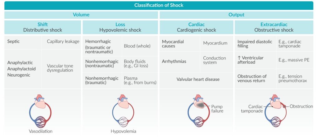 Visión general de los tipos de shock y aspectos de su etiología y fisiopatología. Común a todos los tipos de shock es el desarrollo de hipoperfusión tisular y, en consecuencia, hipoxia tisular y disfunción de órganos terminales.

