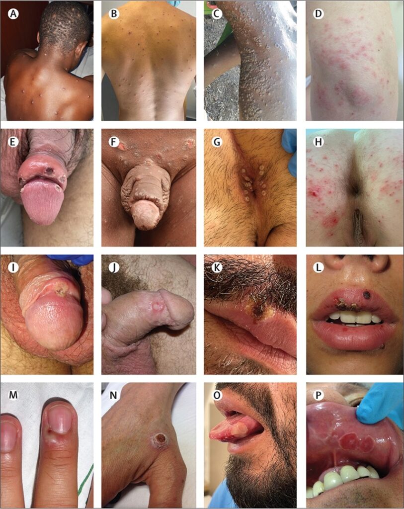 Erupción cutánea discreta en el tórax causada por la viruela del mono (Nigeria; A) y varicela (España; B); una erupción generalizada de la viruela del mono (República Democrática del Congo; C) y una erupción ampollosa causada por la dermatitis herpetiforme (España; D); lesiones localizadas de viruela del mono causantes de edema peneano (España; E) e impétigo asociado a la sarna (Malawi; F); erupción perianal localizada causada por la viruela del mono (España; G) y molusco contagioso (España, H); una úlcera genital solitaria de viruela del mono (España; I) y un chancro primario de sífilis (España; J); lesión labial causada por la viruela del mono (España; K) y herpes simple (España; L); lesiones de las manos causadas por la viruela del mono (España; M) y la infección por el virus Orf (España; N); lesiones de viruela del mono en la lengua (España; O) y úlcera aftosa en la mucosa labial