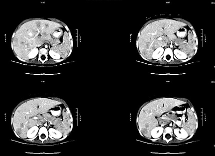 Tomografía computarizada de abdomen en un niño con afectación visceral de Bartonella henselae