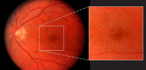 Estrella macular de la afectación ocular con la enfermedad por arañazo de gato