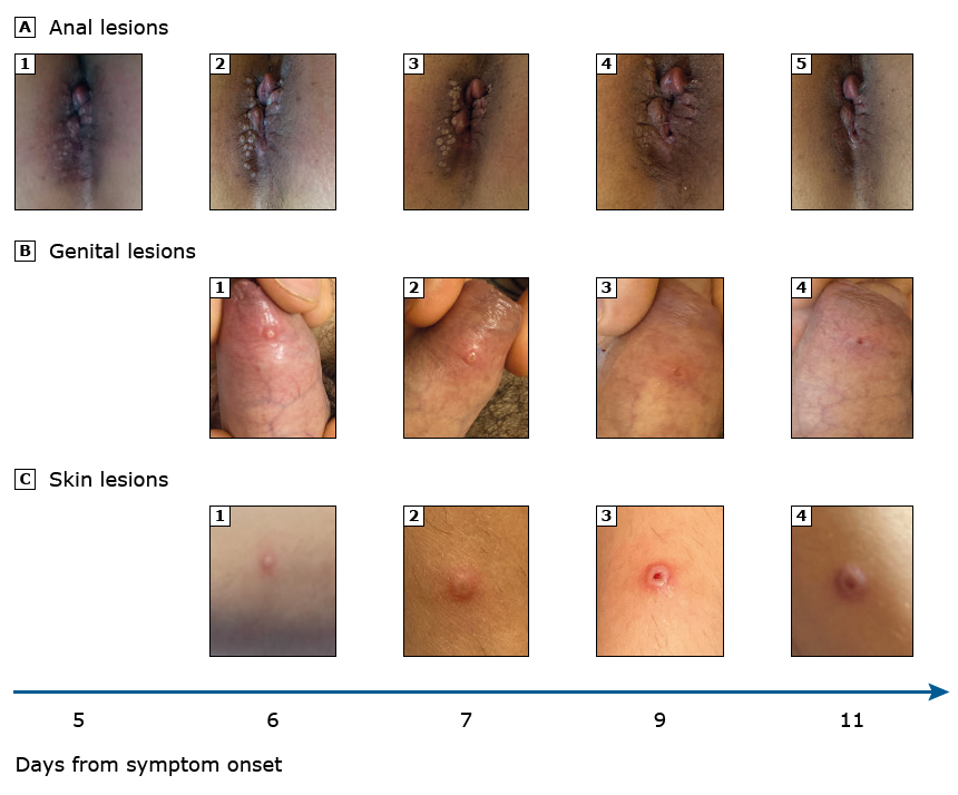 Las lesiones aparecieron de 1 a 3 días después de los síntomas sistémicos, agrupadas (área anal 1A) o aisladas (piel o pene 1B-1C). Por lo general, comenzaron como pápulas elevadas y pruriginosas que secretaban seroso, con una umbilicación central; Con el paso de los días, la umbilicación central se ensanchó hasta que la lesión se abrió y se formó la costra aproximadamente 2 semanas después del inicio de los síntomas.