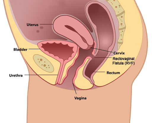 Fístula Recto-Vaginal