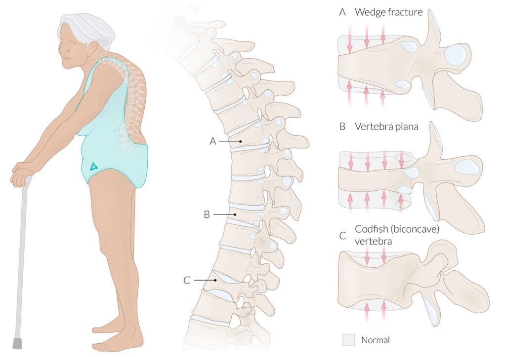 Fracturas por compresión de la vértebra

(A) Fractura en cuña: se caracteriza por una pérdida de altura, predominantemente de la parte anterior del cuerpo vertebral. Las fracturas en cuña son comunes en las personas con osteoporosis y pueden provocar una deformidad cifótica de la columna vertebral (gibbus) si se ven afectadas varias vértebras.

(B) Vértebra plana: fractura por compresión avanzada en la que se produce una pérdida de altura de todo el cuerpo vertebral, tanto anterior como posterior. La vértebra plana también se conoce como panqueque o vértebra de moneda en el borde.

(C) Vértebra de bacalao: se caracteriza por la pérdida de altura de la parte central del cuerpo vertebral, lo que resulta en un cuerpo vertebral bicóncavo que se asemeja a las vértebras de los peces.