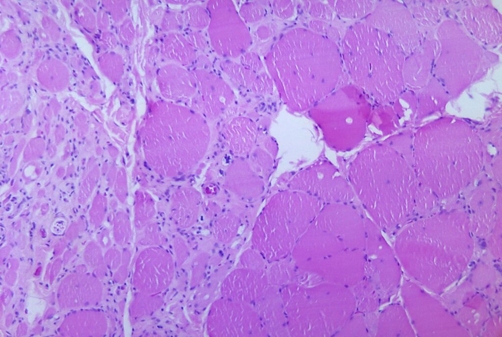 Poliomielitis

Fotomicrografía de un espécimen de biopsia de músculo esquelético (tinción H&E; aumento alto)

La fibrosis intersticial (ejemplos indicados con puntas de flecha) y la distrofia miotónica (ejemplos marcados con una capa amarilla) debido a la extinción de las motoneuronas alfa (denervación), secundaria a la infección por poliovirus, se pueden ver a la izquierda, mientras que todavía hay varias fibras musculares intactas visibles en la mitad derecha de la imagen (ejemplos marcados con una superposición azul).

Este aspecto es característico de la poliomielitis.