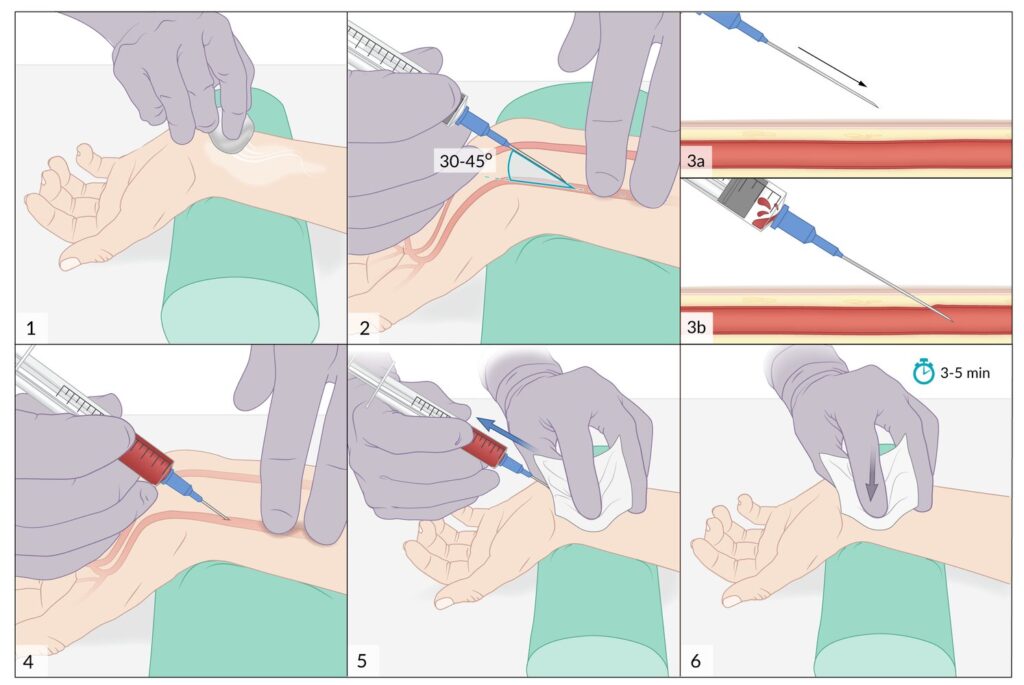 Punción de la arteria radial con muestreo de gasometría arterial (GAB)