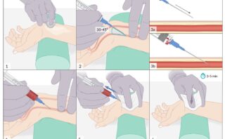 Hipertensión Arterial: Enfoque Clínico y Terapéutico