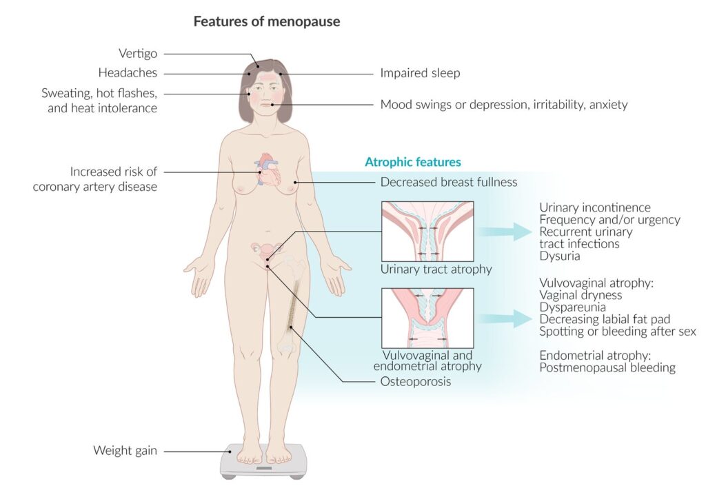 Características clínicas de la menopausia