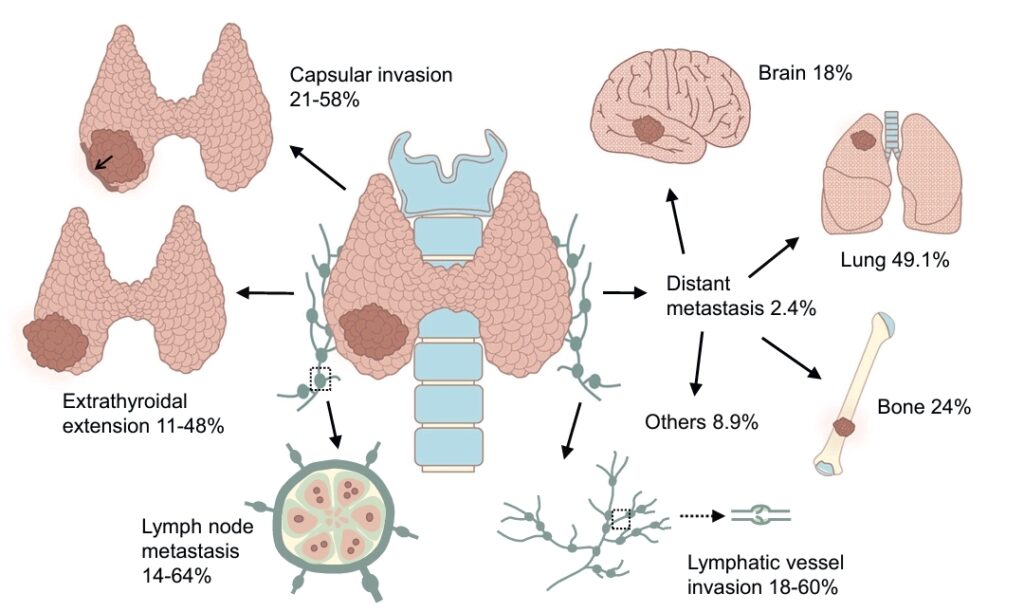 Capacidad metastásica del carcinoma papilar de tiroides.