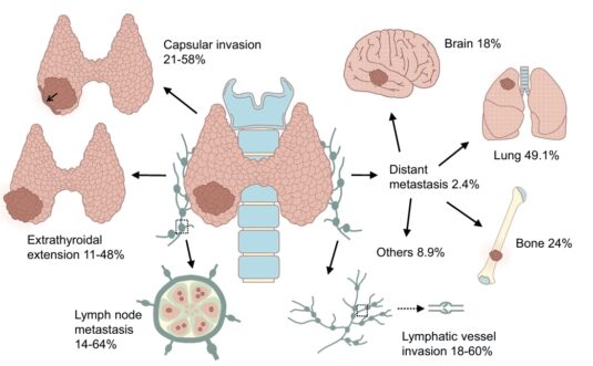 Síndrome de Intestino Irritable (SII)