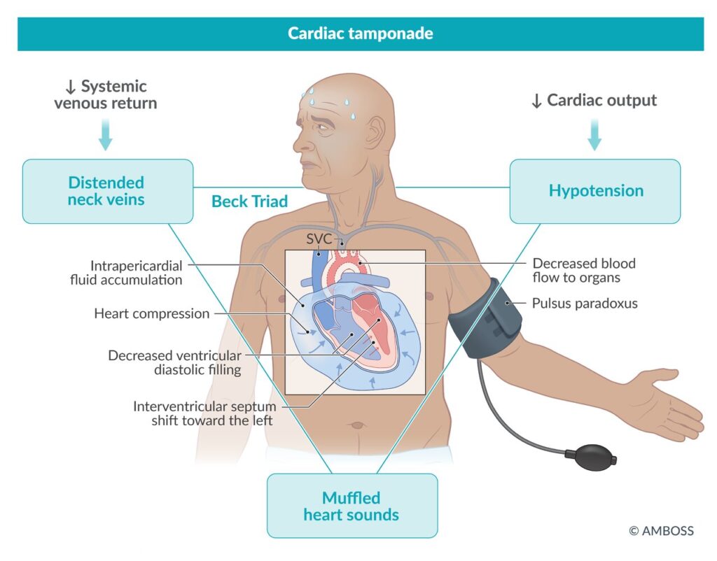 Taponamiento cardíaco