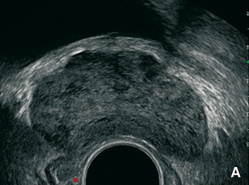 Ecografía transrectal de la próstata, mostrando una estructura irregular y áreas hipoecoicas, asociadas a lesiones de malignidad.