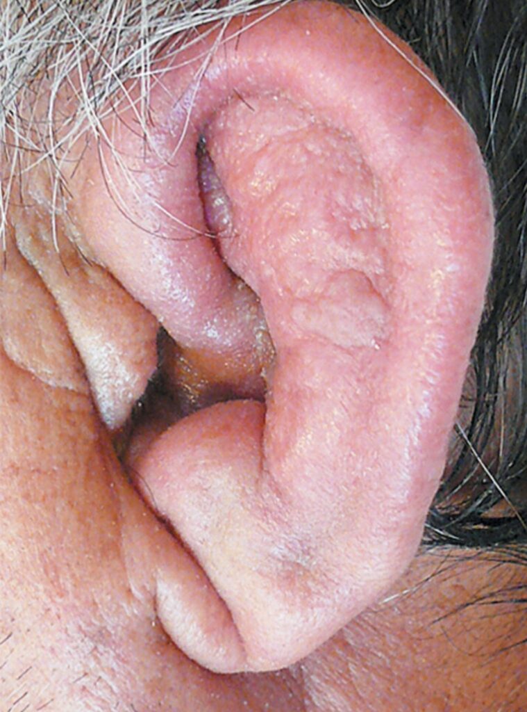 Condritis auricular asociada a policondritis recidivante. Se aprecia inflamación del cartílago con eritema y edema, respetando el lóbulo de la oreja