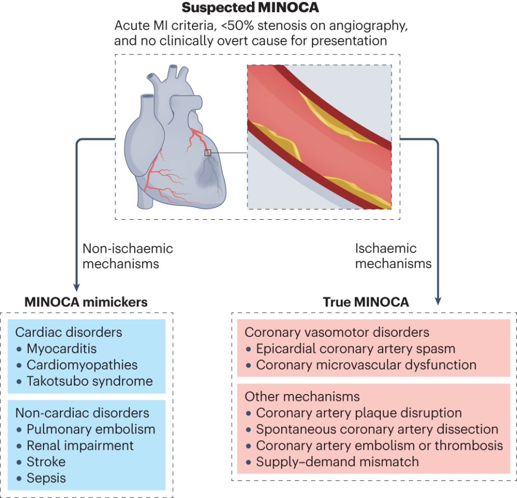 diagrama del proceso diagnóstico y las posibles etiologías en casos sospechosos de MINOCA (Infarto Agudo de Miocardio Sin Lesiones Coronarias Obstructivas).