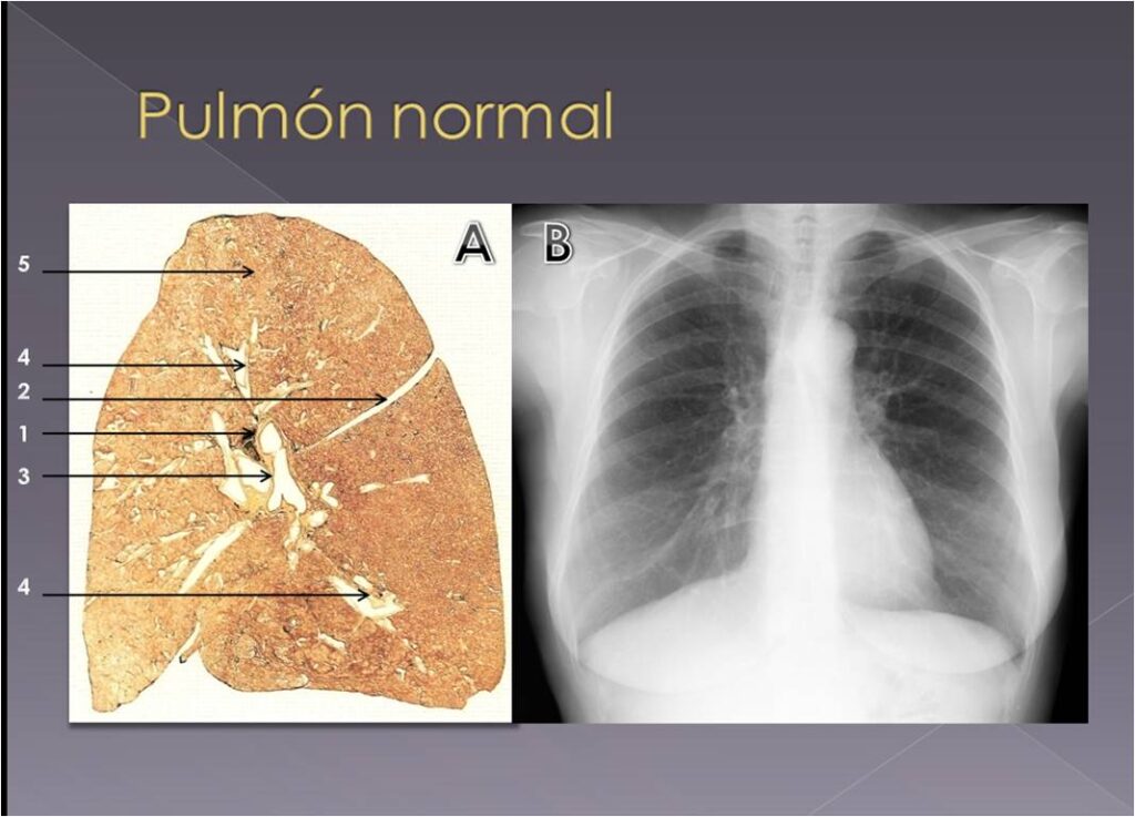 A: Pulmón normal, muestras de anatomía macroscópica según la técnica de las macrosecciones de Gough y Wentworth, que permite obtener representaciones demostrativas y de gran valor iconográfico (Antibióticos S.A.) 1.- Hilio pulmonar 2.- Cisura mayor 3.- Bronquio principal 4.- Bronquios lobares 5.- Alveolos pulmonares. B: Pulmón normal, radiografía(Rx) póstero-anterior(PA) de tórax