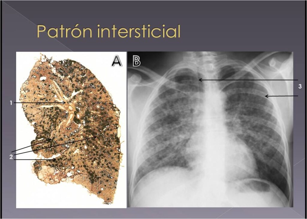 A: Patrón nodular fino y difuso - Silicosis (muestra macroscópica)(Antibióticos S.A.) 1.- Bronquio. 2.- Micronódulos silicóticos. B: Patrón reticular fino y difuso – Neumonía aguda intersticial bilateral (Rx PA de tórax) perteneciente a otro paciente. 3.- Múltiples imágenes de aumento de densidad, micronodulares, diseminadas por ambos campos pulmonares. Se trataba de un caso de neumonía por Varicela.