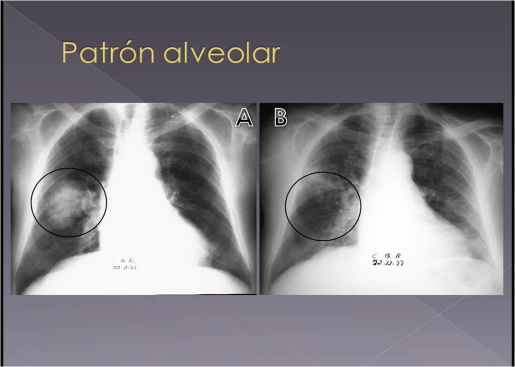 A: Patrón alveolar - "neumonía redonda" (Rx PA de tórax) Imagen de aumento de densidad, de forma redondeada y bordes mal delimitados en la ubicación de la cisura menor en relación con condensación alveolar. B: Patrón alveolar - (Rx PA de tórax del mismo paciente realizada 10 días después) Luego que el paciente hubiera recibido correcto tratamiento de depleción de líquidos la “neumonía” desaparece en un tiempo menor del esperado.