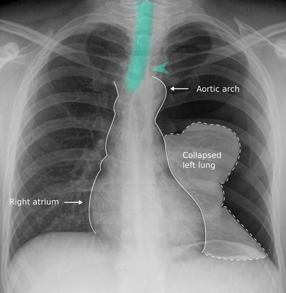 Radiografía de tórax que muestra un neumotórax con colapso pulmonar izquierdo. Se observa el desplazamiento del mediastino hacia la derecha, con el arco aórtico y el atrio derecho marcados. El pulmón izquierdo colapsado está delineado con un contorno punteado, y la tráquea parece desplazada, lo que sugiere un posible neumotórax a tensión.