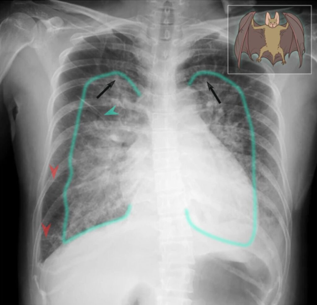 La imagen es una radiografía de tórax con anotaciones superpuestas. Estas anotaciones incluyen líneas y flechas de colores que resaltan ciertas estructuras y áreas en el tórax, junto con una imagen de un murciélago en la esquina superior derecha