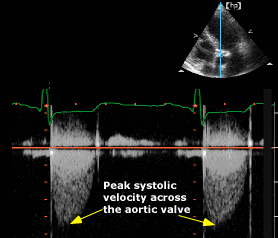 Imagen de ecocardiografía Doppler continuo que muestra el pico de velocidad sistólica a través de la válvula aórtica, indicativo de estenosis aórtica y utilizado para evaluar la severidad de la obstrucción del flujo