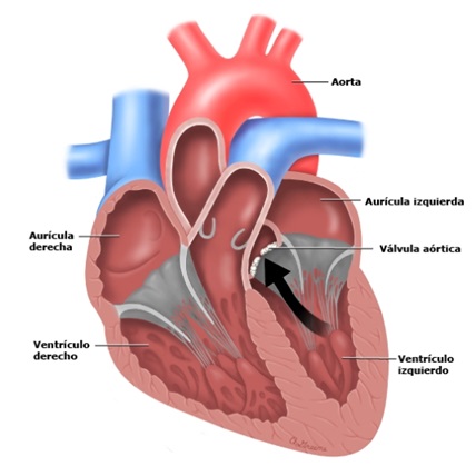 Diagrama anatómico del corazón que muestra estenosis aórtica, las aurículas y los ventrículos, así como el flujo de sangre restringido hacia la aorta debido al estrechamiento de la válvula