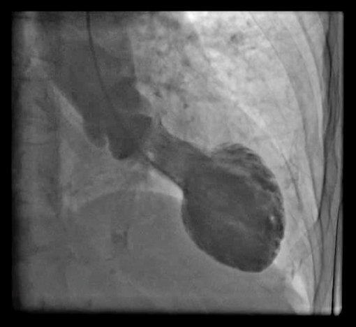 Ventriculografía de un paciente con síndrome de Takotsubo, mostrando la característica forma de 'tako-tsubo' con abombamiento apical y estrechamiento en la base del ventrículo izquierdo.