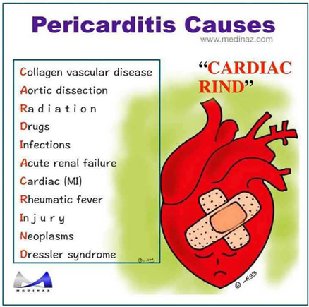 Acrónimo "CARDIAC RIND" para recordar las principales causas de pericarditis