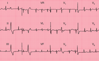 Infarto de Miocardio Inferior Antiguo | CASO CLÍNICO