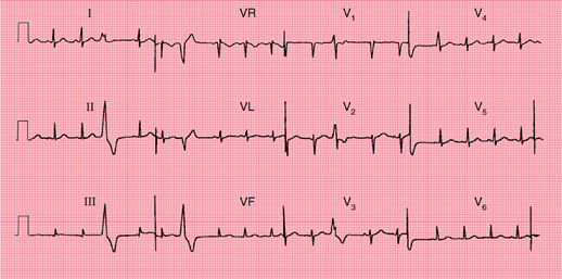 Electrocardiograma de 12 derivaciones que muestra un ritmo sinusal interrumpido por extrasístoles ventriculares aisladas. Los latidos ectópicos presentan complejos QRS anchos y prematuros sin ondas P previas, lo cual es característico de los latidos ventriculares prematuros.