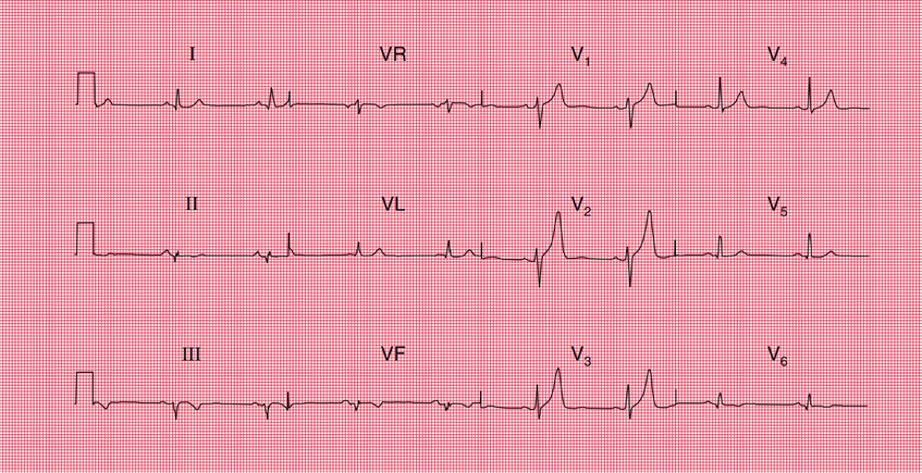 Electrocardiograma que muestra ondas Q patológicas en las derivaciones inferiores (DII, DIII, aVF), indicativo de un infarto de miocardio inferior antiguo. No hay elevación del segmento ST ni signos de infarto agudo.