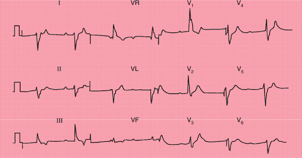 Electrocardiograma mostrando un bloqueo cardíaco completo, con disociación auriculoventricular.