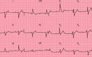 Infarto de Miocardio Inferior Antiguo | CASO CLÍNICO